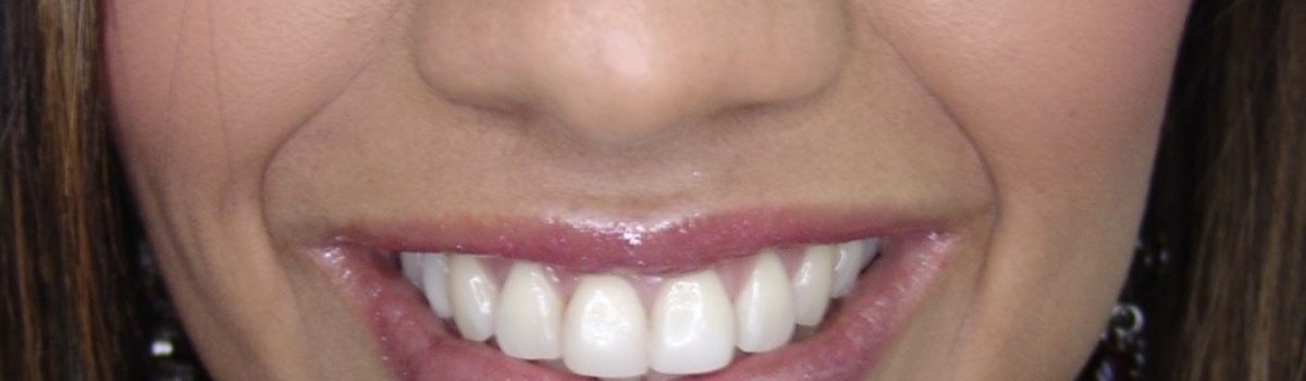 Estética dental – Alargamiento incisal