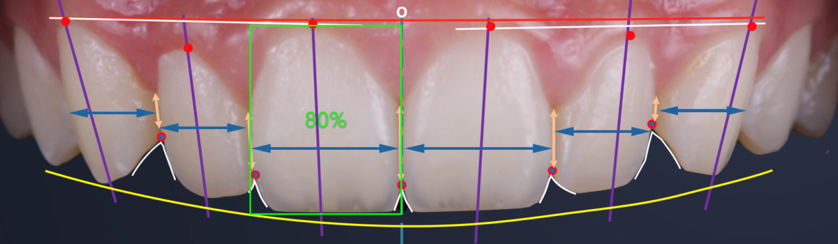 Caso clínico – Laminados Cerámicos con tecnología CAD-CAM, mito o verdad.